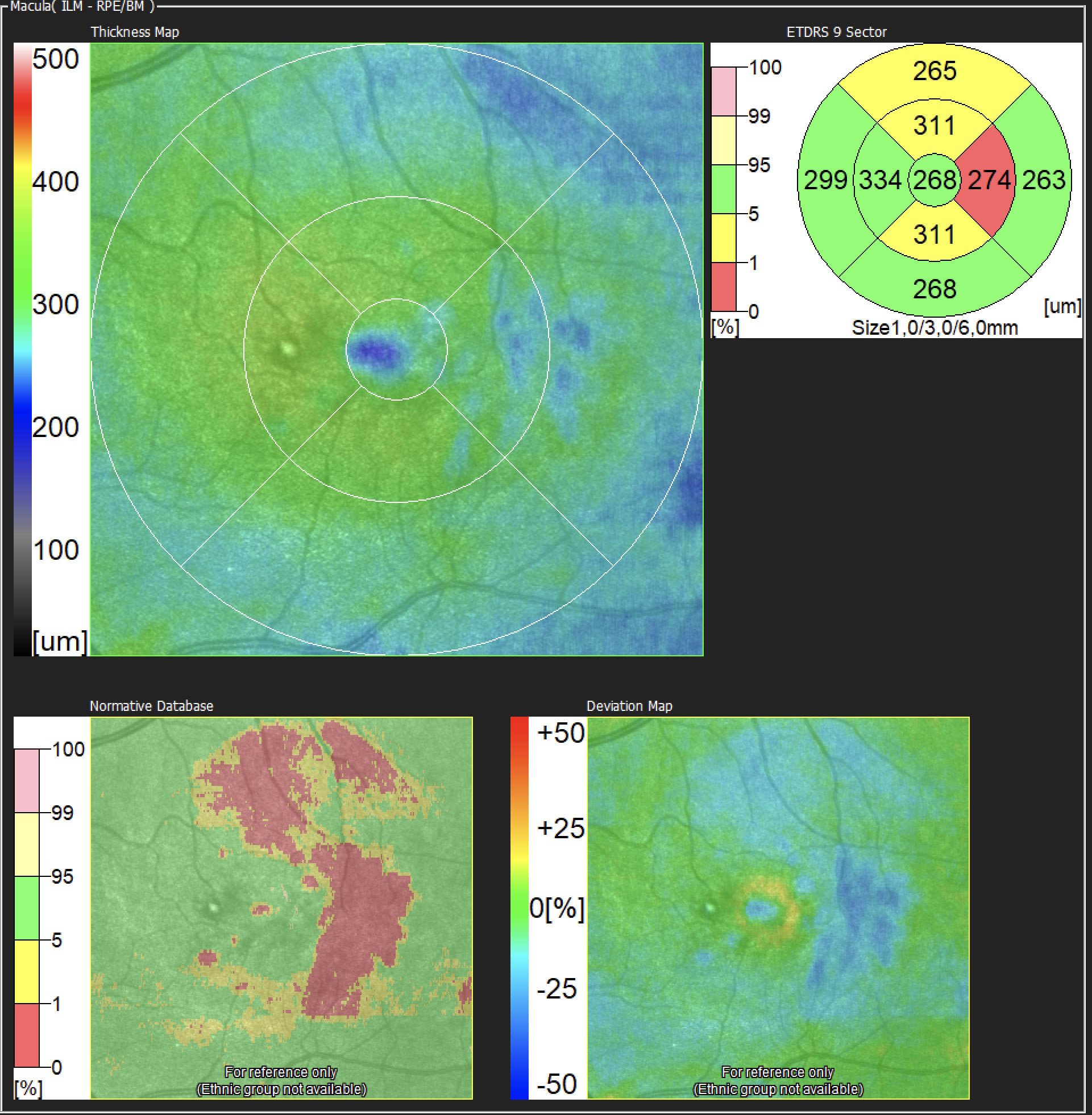 dissociated-optic-nerve-fiber-layer-donfl-retinography