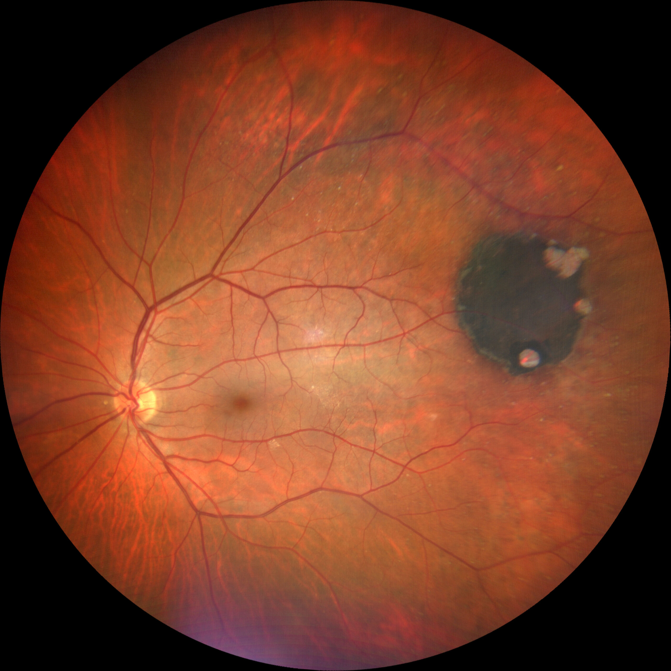 Congenital hypertrophy of the retinal pigment epithelium – Retinography