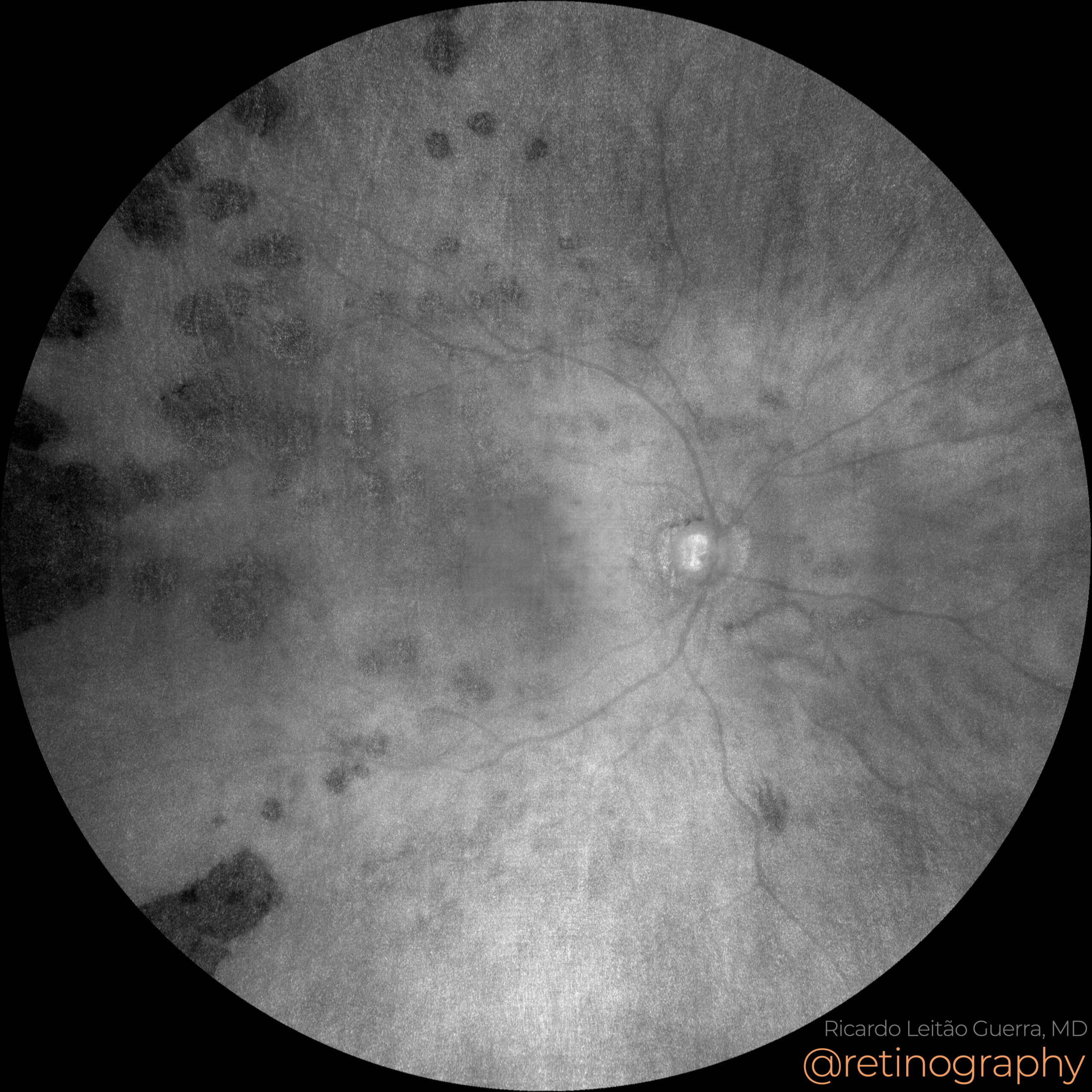 Bear track CHRPE – Retinography