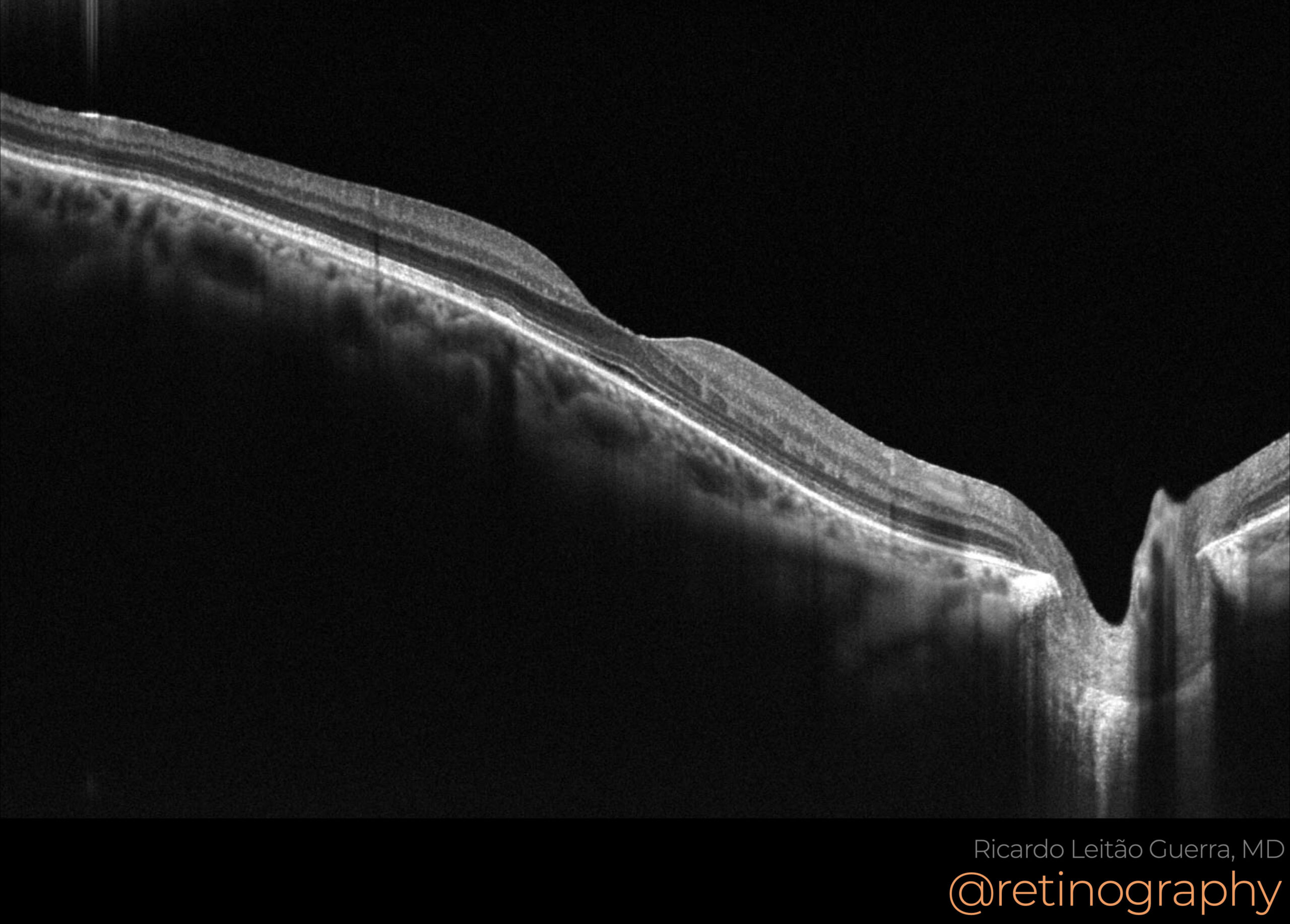 Bear track CHRPE – Retinography