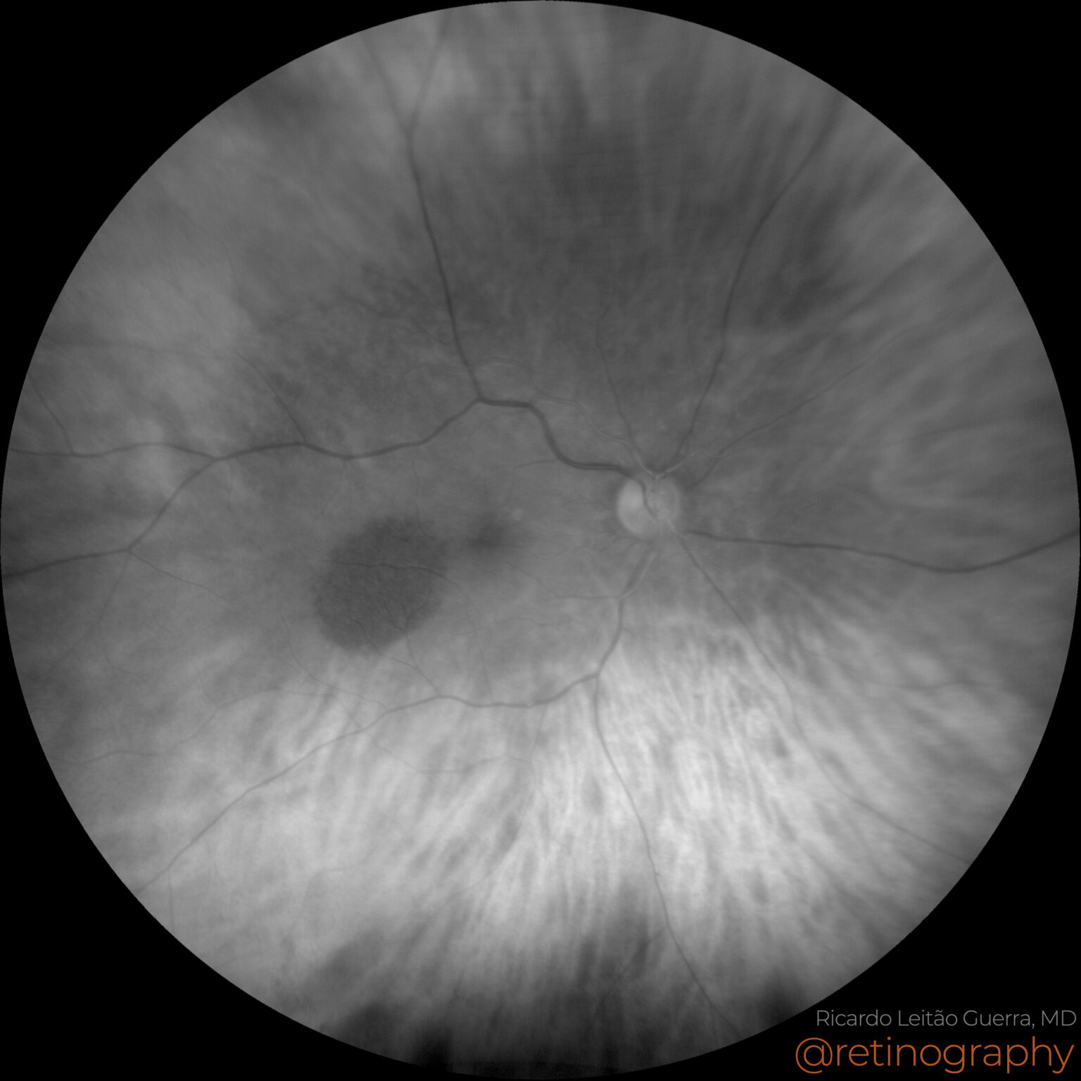 Choroidal nevus – Retinography