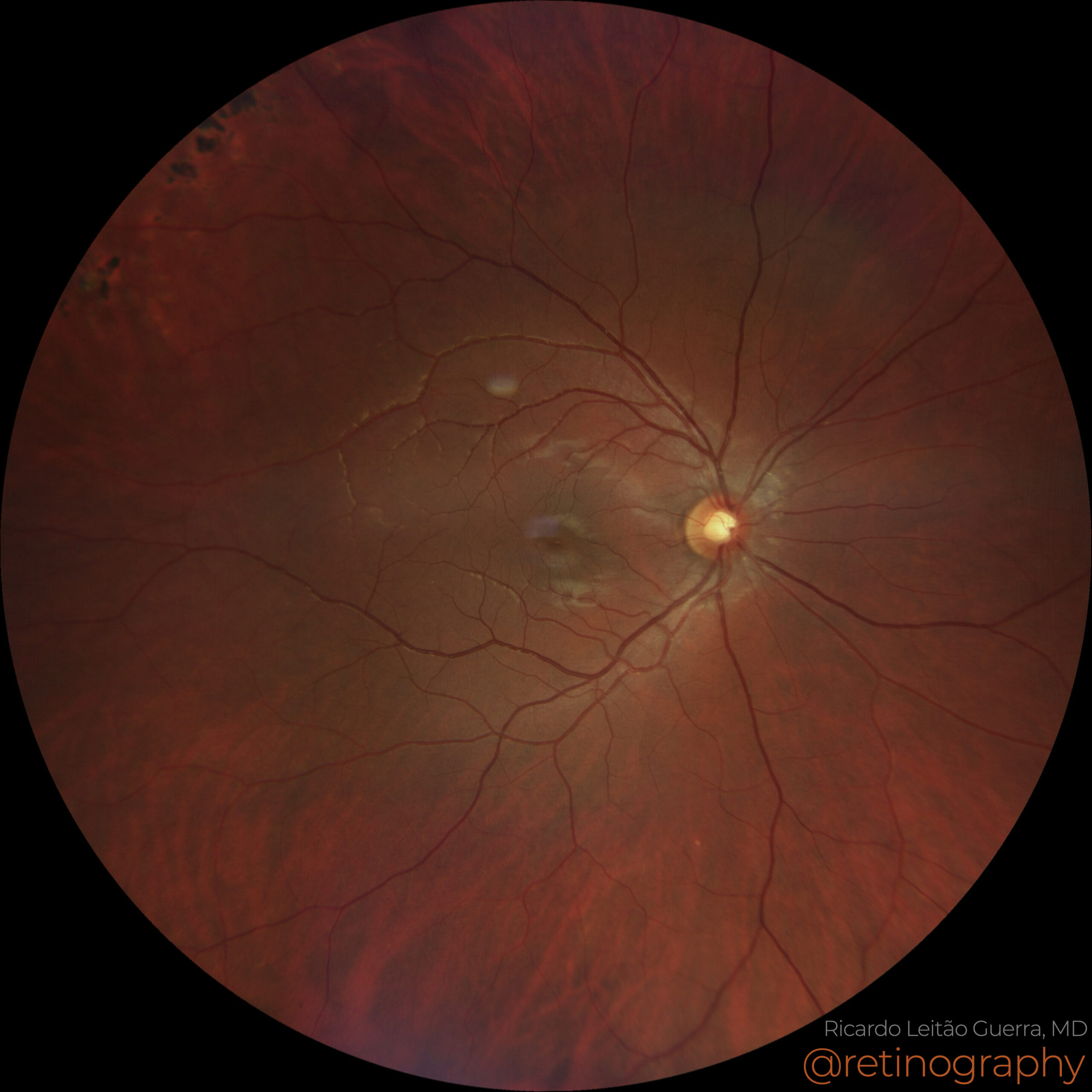 Foveal hypoplasia – Retinography