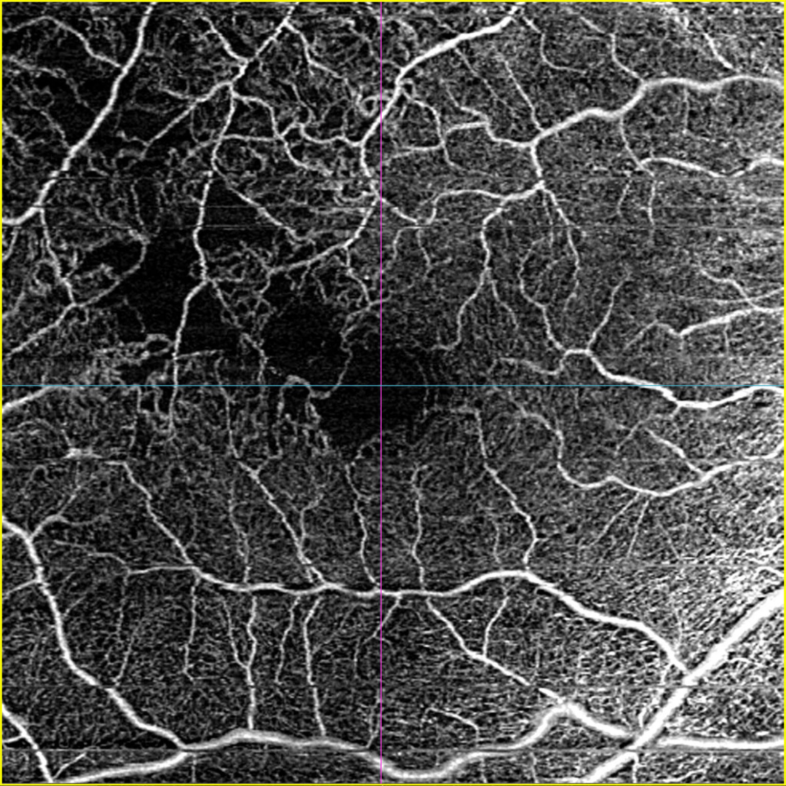 BRVO – Macular schemia – Retinography