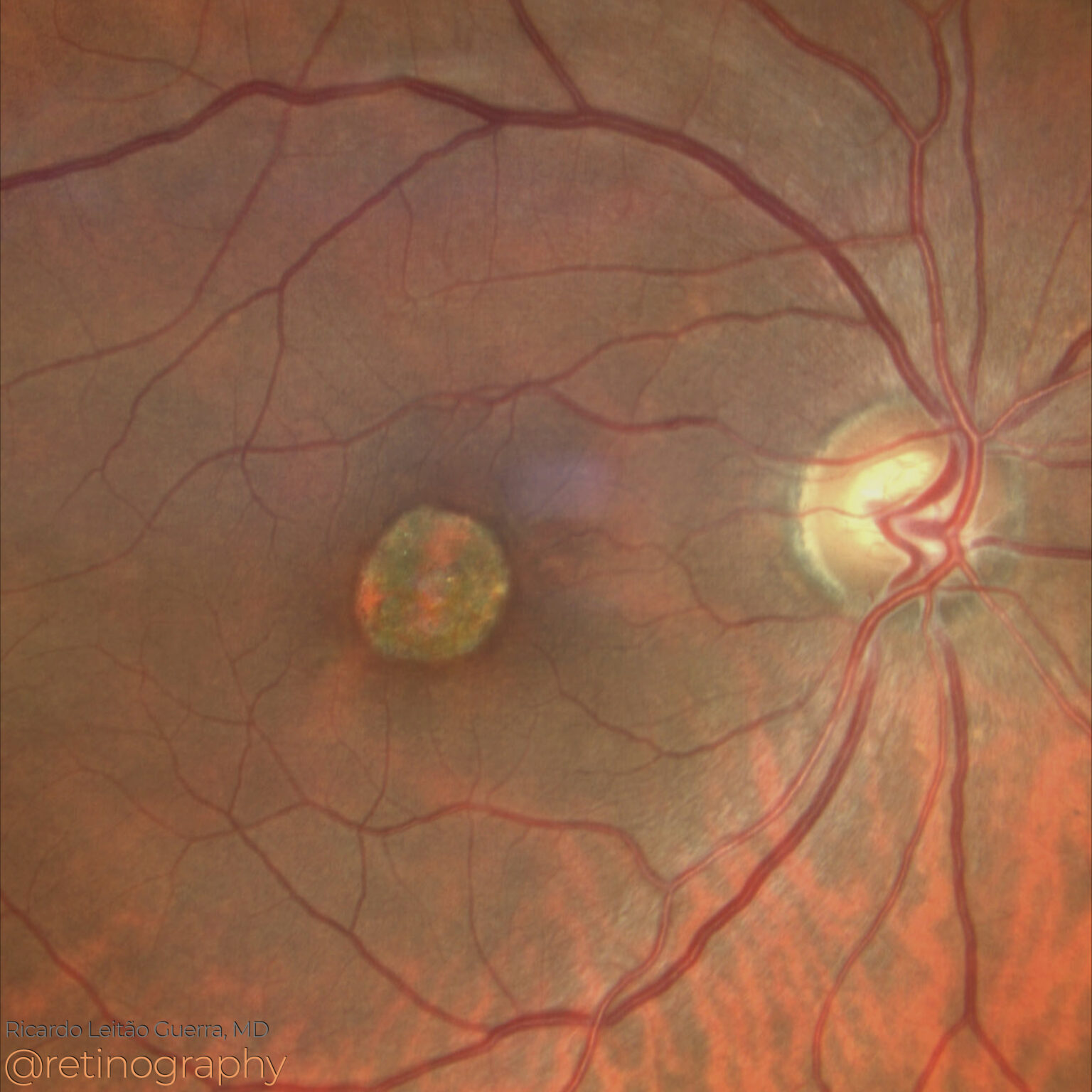 Central Areolar Choroidal Dystrophy – Retinography
