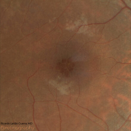 CME in Retinitis pigmentosa