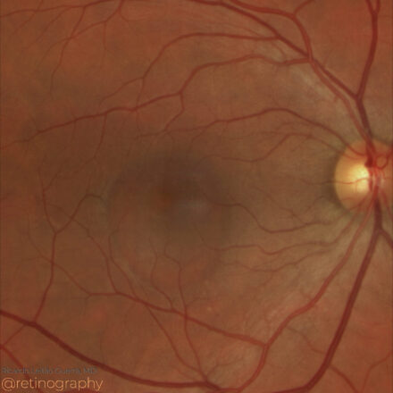 Central Serous Chorioretinopathy