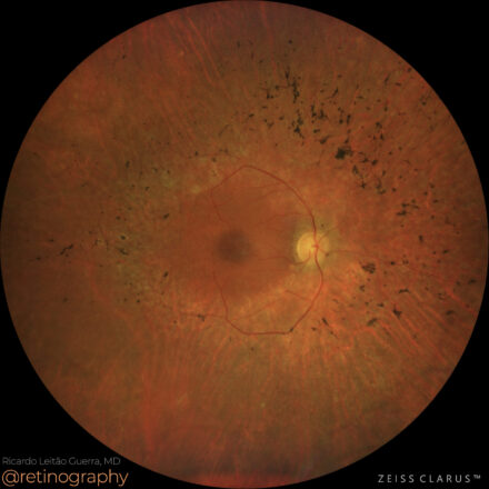 Retinitis pigmentosa