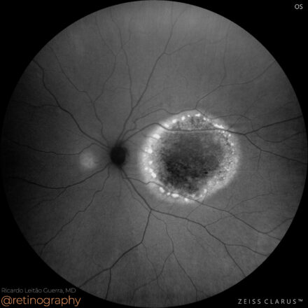 Best’s vitelliform dystrophy