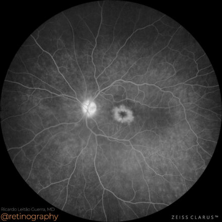 Cystoid macular edema