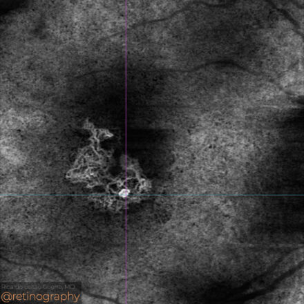 aneurysmal Type 1 MNV