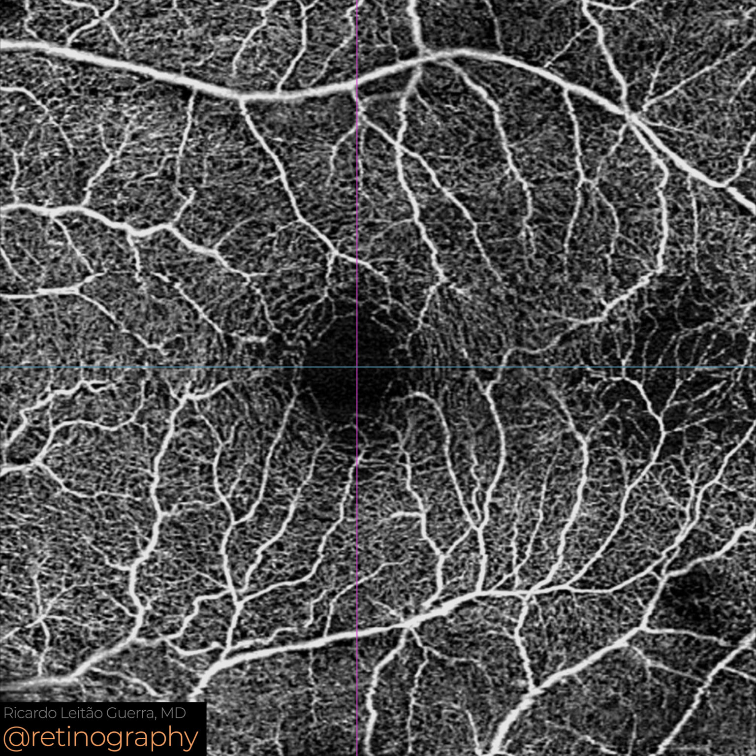 Retinal ischemia – Retinography