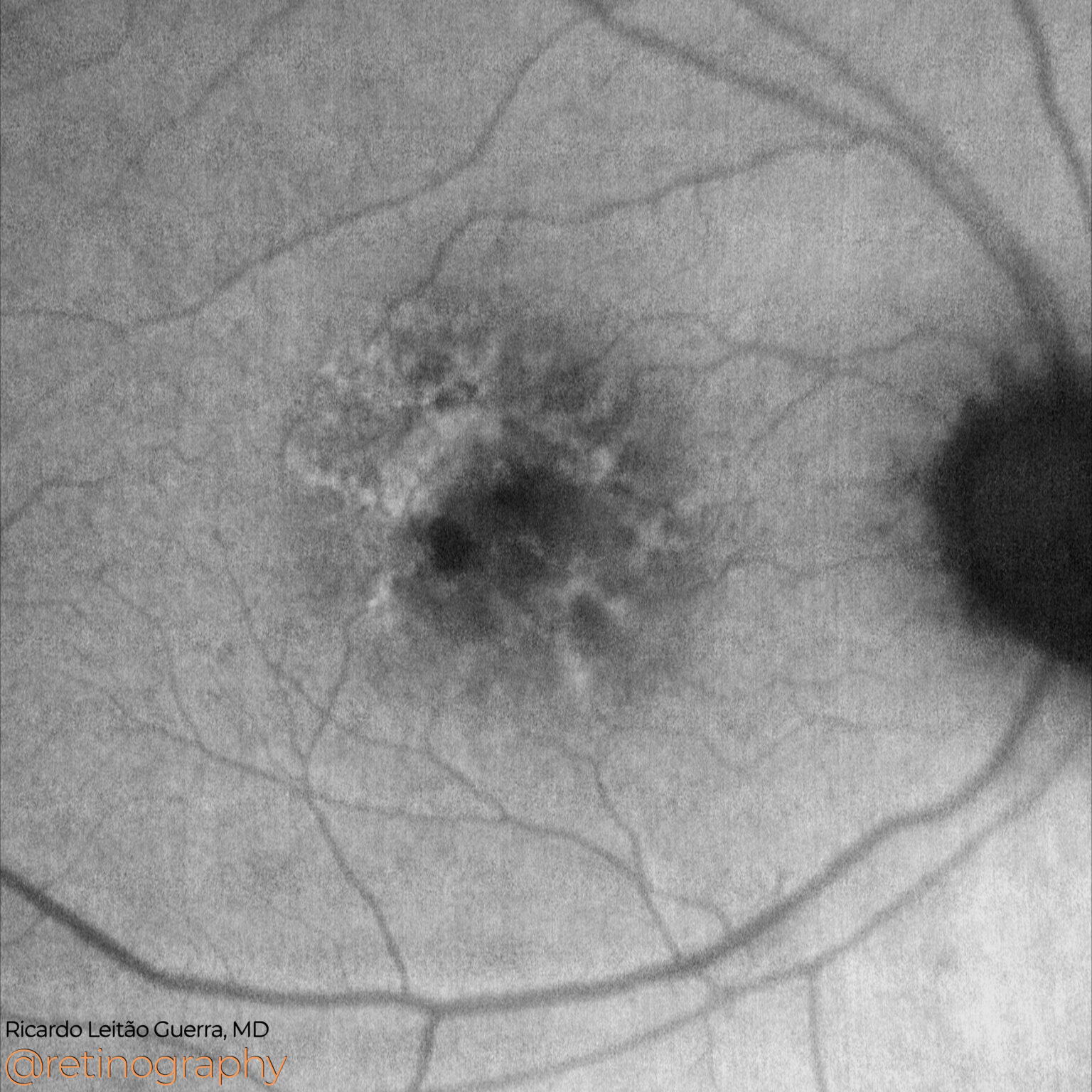 PCV: RPE tear – Retinography