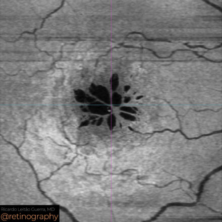 CME and Neovascular AMD