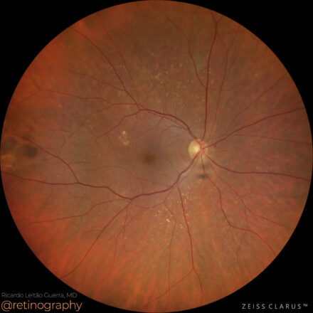 Peripheral hemorrhagic exudative chorioretinopathy