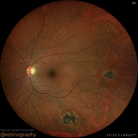 Sickle cell retinopathy