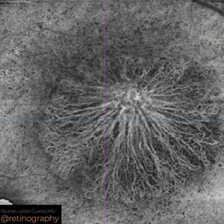 Neovascular AMD