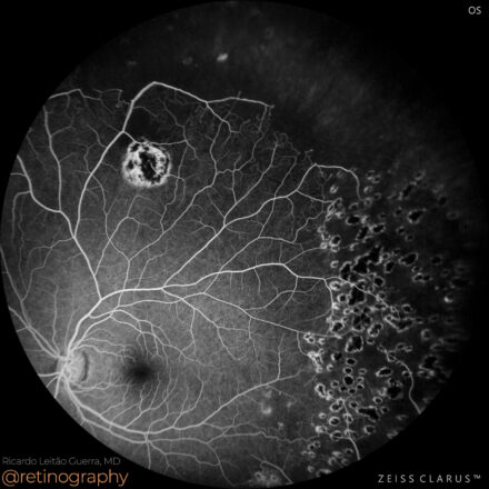 Sickle cell retinopathy