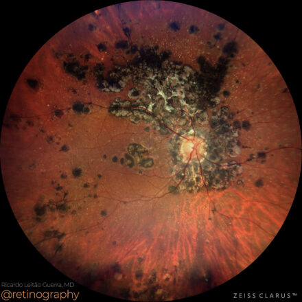 Serpiginous-like choroiditis