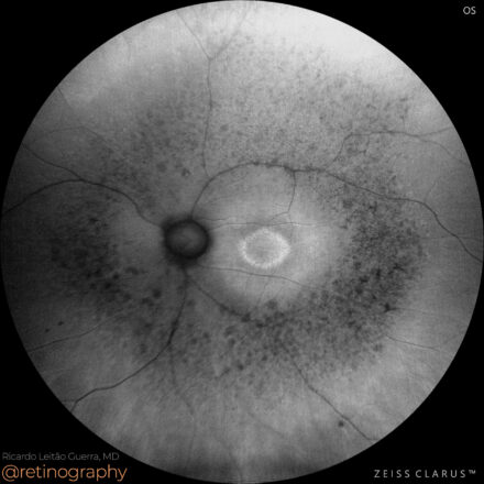 Retinitis pigmentosa