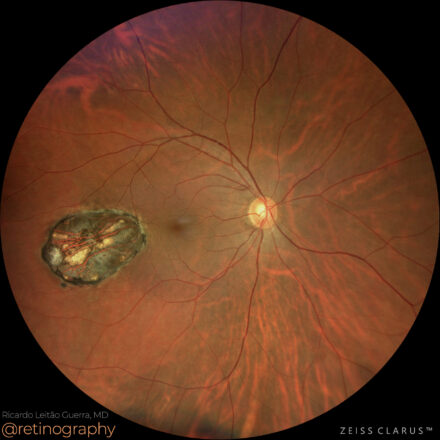 Chorioretinal colobomatous scar