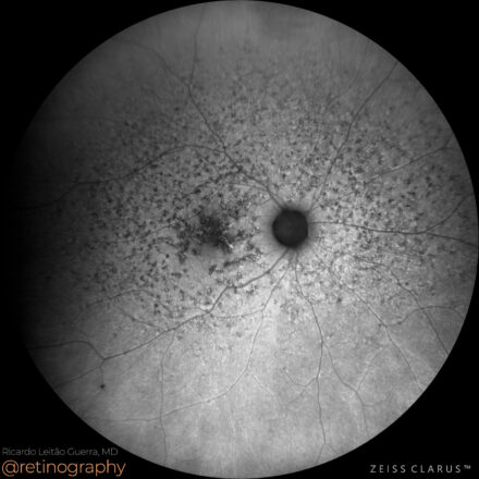 Retinal dystrophy – PRPH2