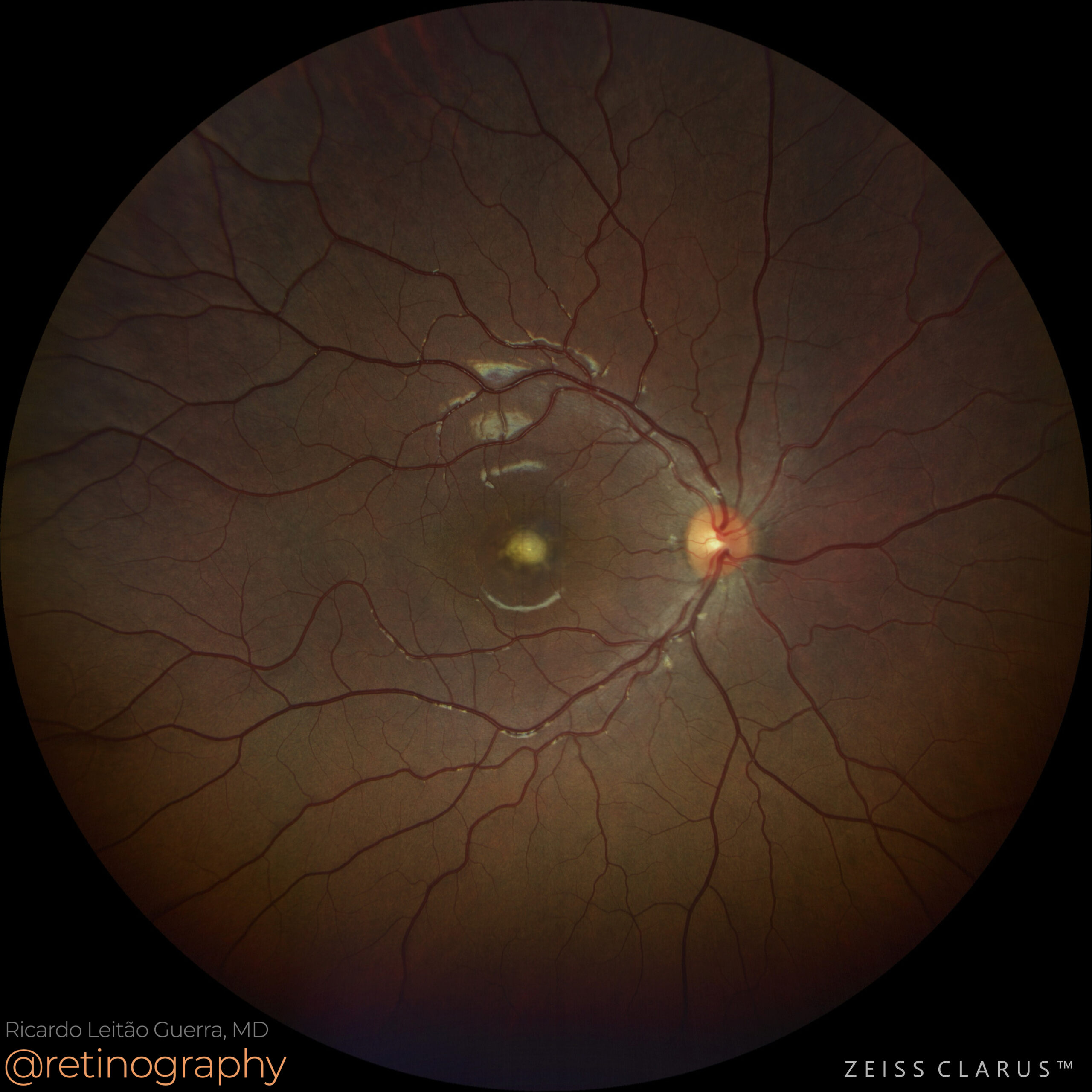 Vitelliform Maculopathy Best Disease: Background, Pathophysiology,