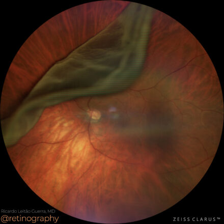 Giant retinal tear detachment