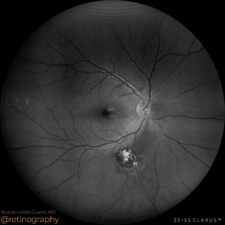 Ocular toxoplasmosis