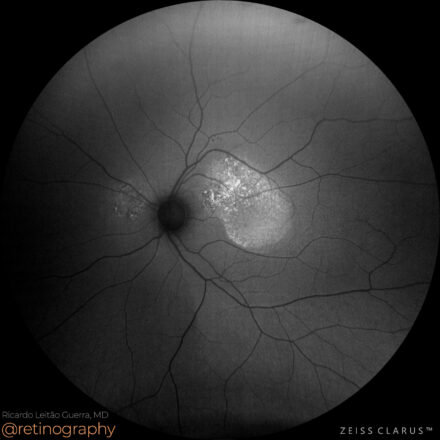 Central Serous Chorioretinopathy