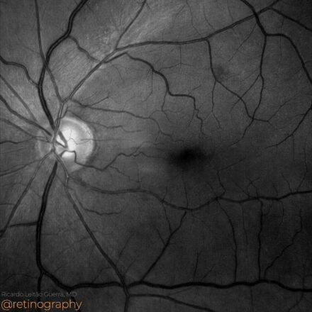 Arcuate RNFL defect