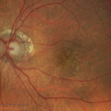 Age-Related Macular Degeneration