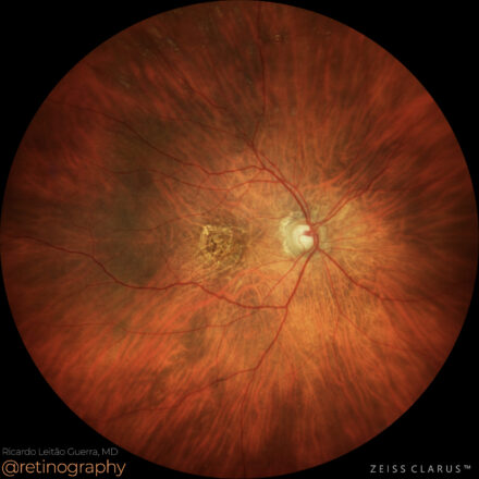 Neovascular AMD