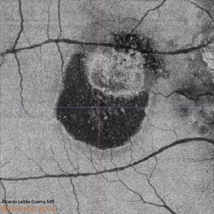 Polypoidal Choroidal Vasculopathy