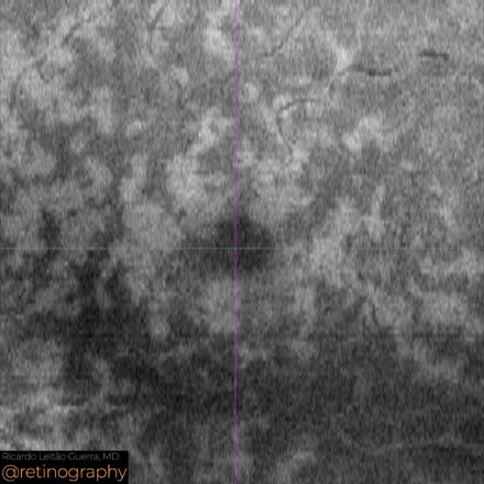 PAMM due to Central Retinal Vein Occlusion