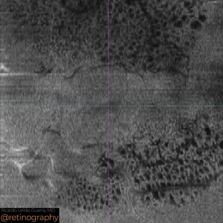 Degenerative cystoid spaces following ERM peeling