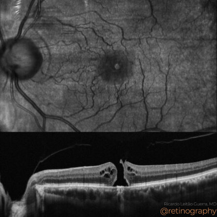 Macular hole