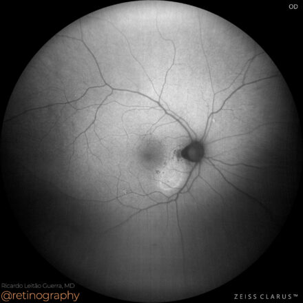 Central Serous Chorioretinopathy