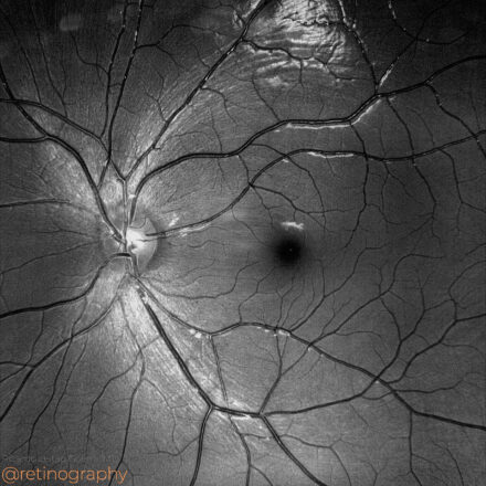 Cilioretinal artery