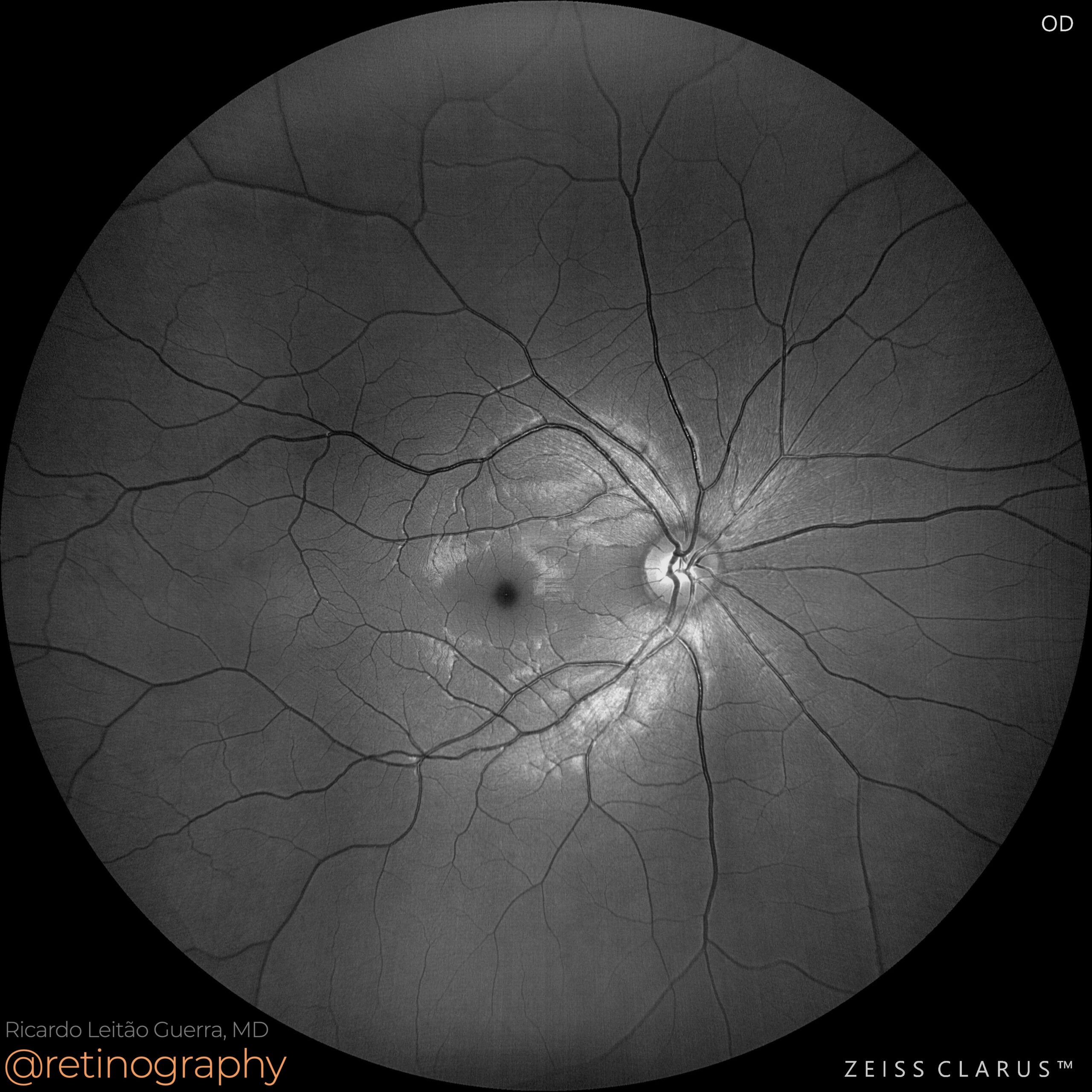 “Bear track” CHRPE – Retinography