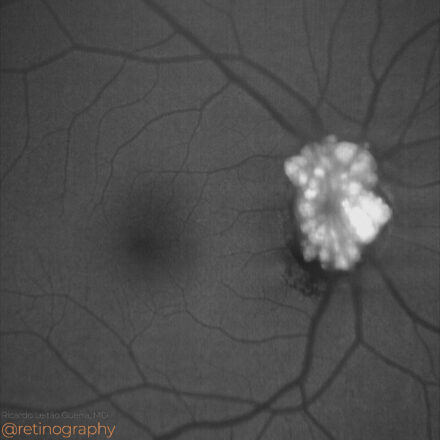 Optic disc drusen