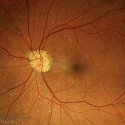 Optic disc drusen