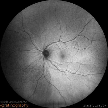 Low-integrity retinal attachment