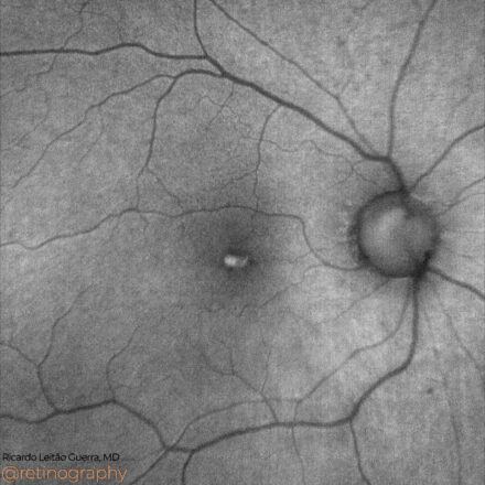 Acquired Vitelliform Lesion