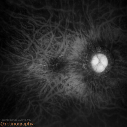 Degenerative myopia: Tessellated fundus