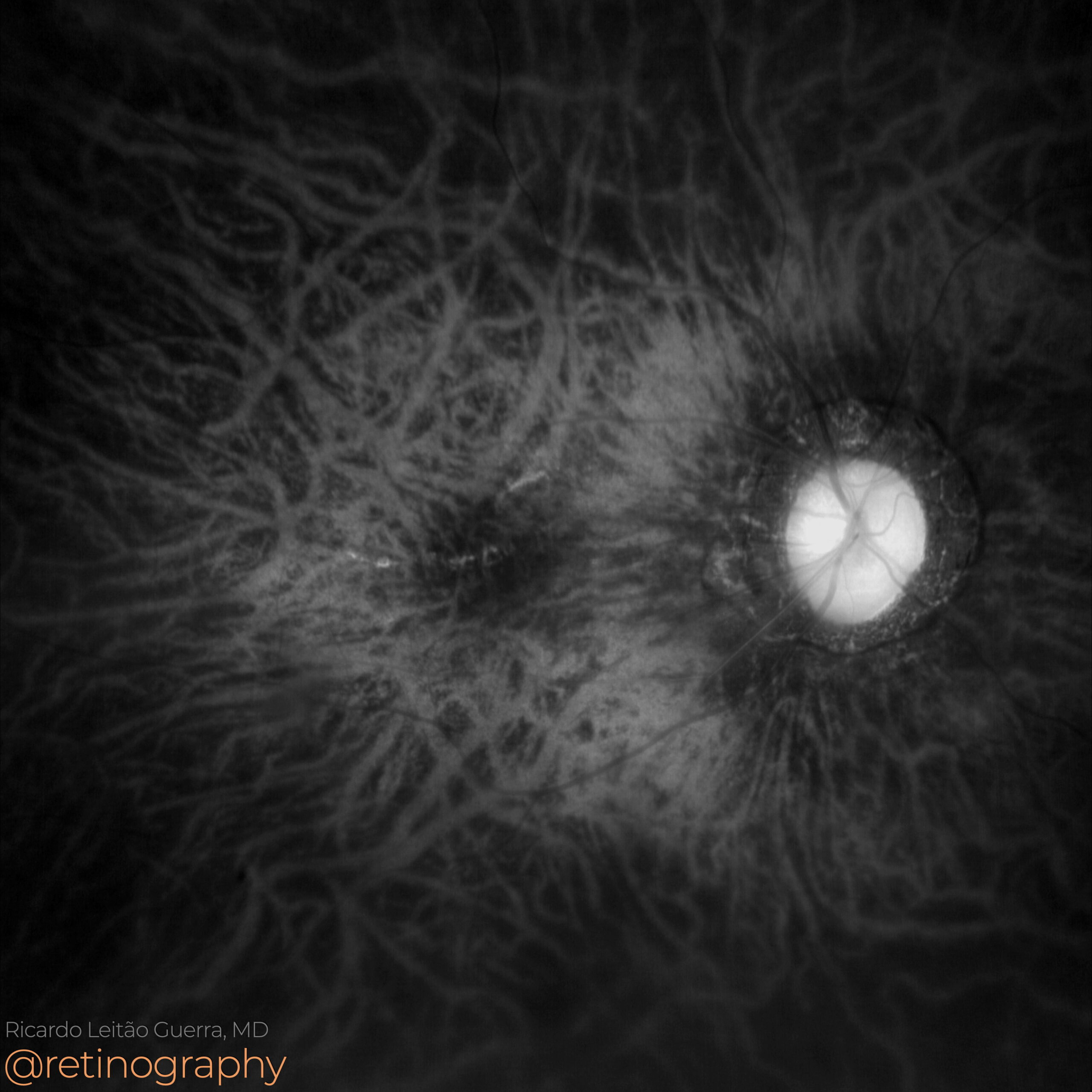 Degenerative myopia: Tessellated fundus – Retinography