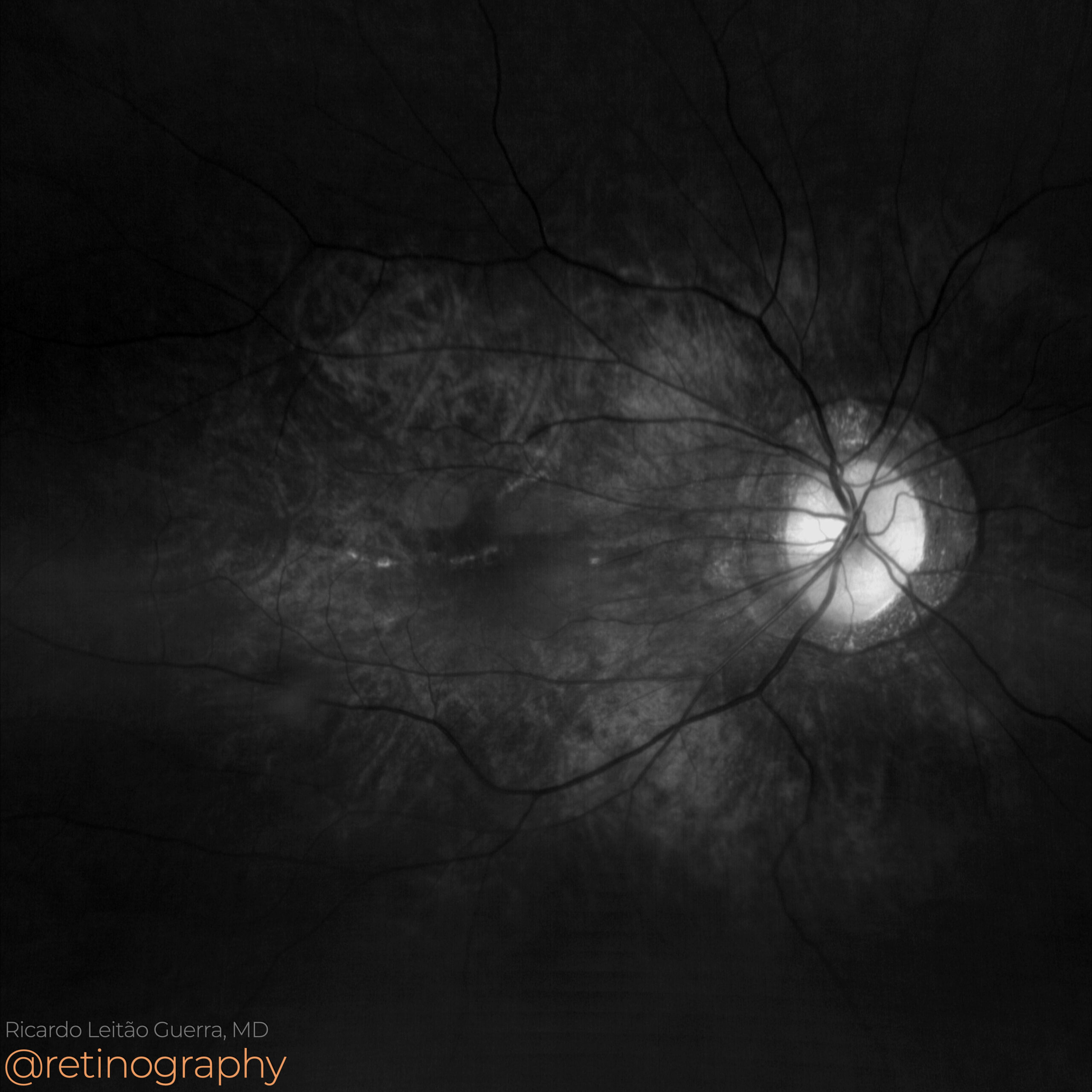 Degenerative myopia: Tessellated fundus – Retinography