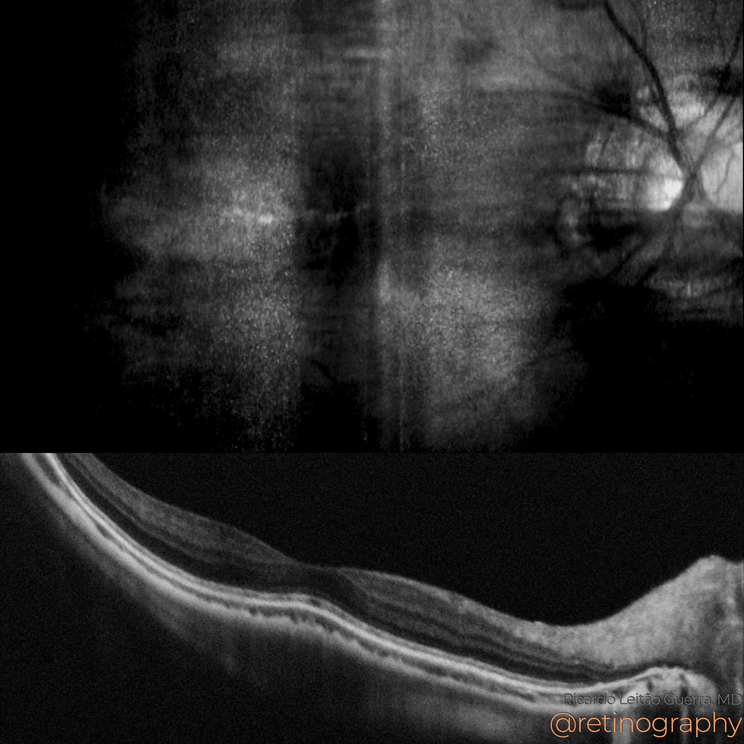 Degenerative myopia: Tessellated fundus – Retinography