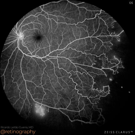 Sickle cell retinopathy