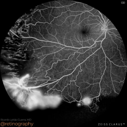 Proliferative Sickle cell retinopathy