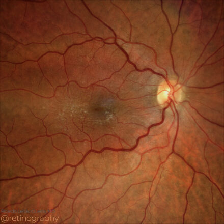 Epiretinal membrane